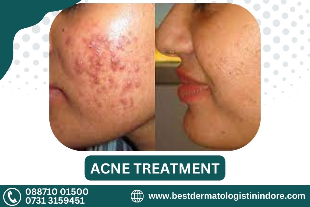 Best Skin Doctor for Acne in Indore